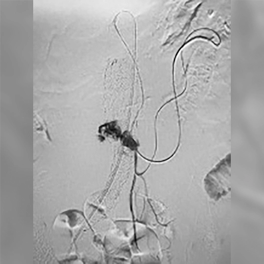 angiogram of Embolization Coils deployed into the body