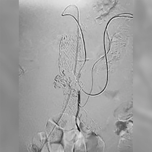 angiogram of Embolization Coils being deployed into the body