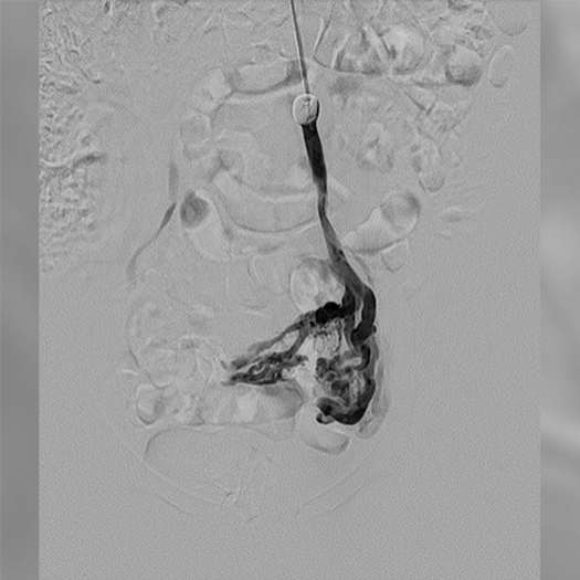 Angiogram showing pelvic congestion syndrom prior to embolization