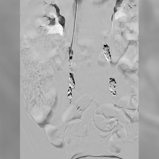 Angiogram showing embolization with Packing Coils to treat pelvic congestion