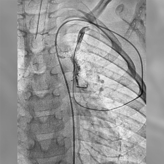 angiogram of device in a vessel