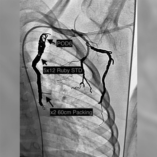 angiogram of embolization coils deployed in the body