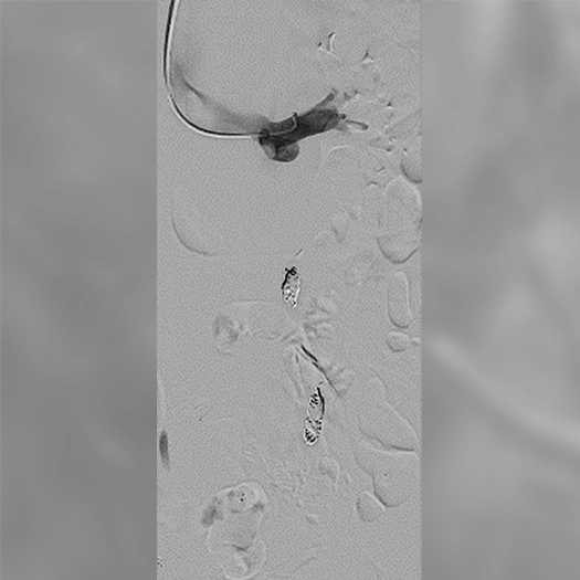angiogram of embolization coils placed in the body