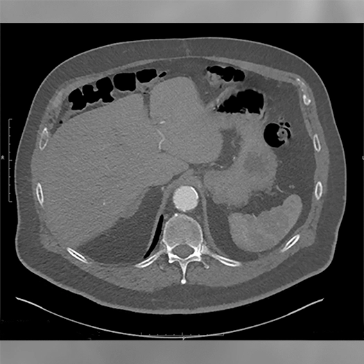 Angiogram of blood vessels in the body