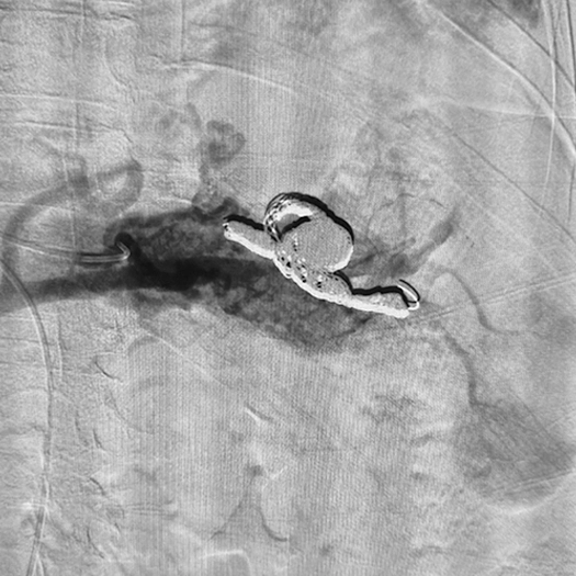 angiogram of coil deployed in the body