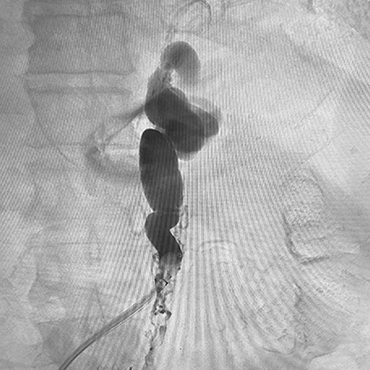 ANGIOGRAM OF A VESSEL IN THE BODY