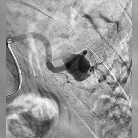 angiogram of an aneurysm in the body
