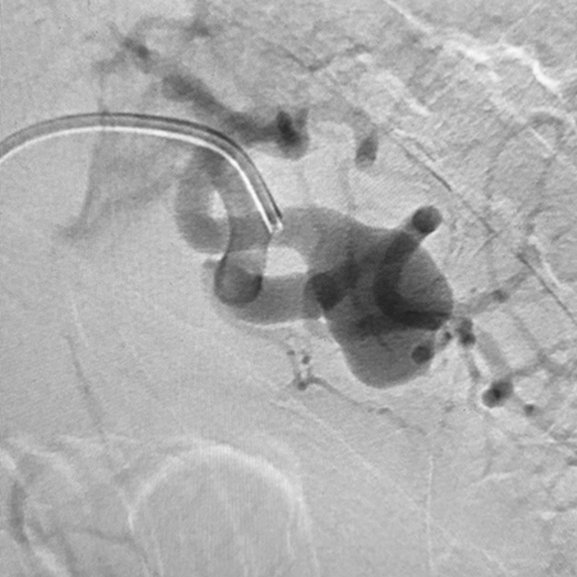 angiogram of an aneurysm in the body