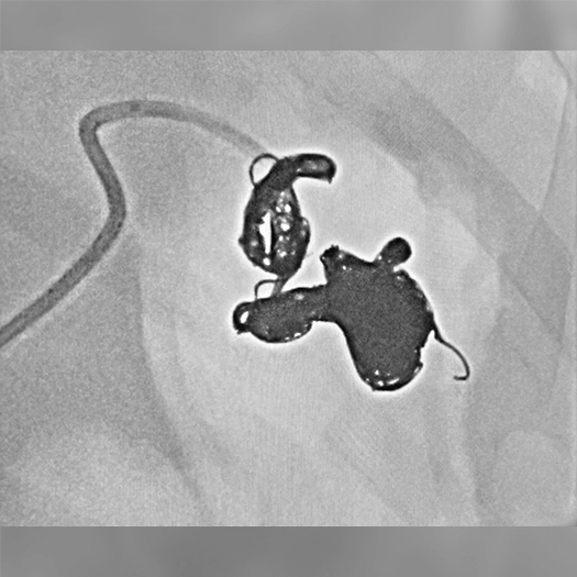 Angiogram of embolization coils deployed into an aneurysm in the body