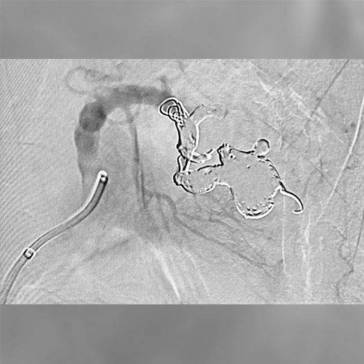 Angiogram of embolization coils deployed into an aneurysm in the body