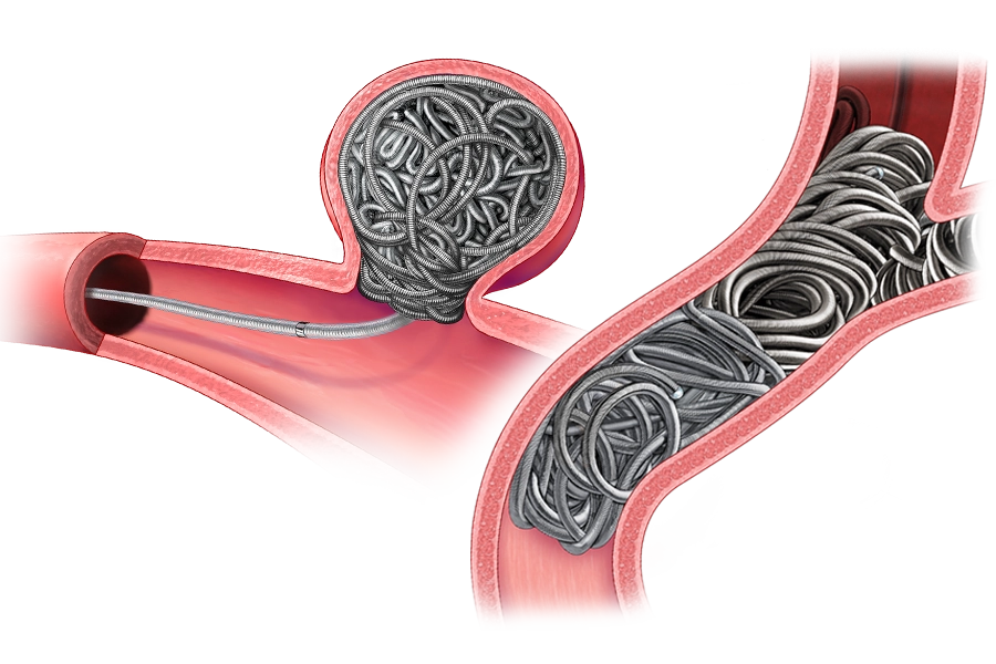 Illustration of Embolization coils within vessels of the body
