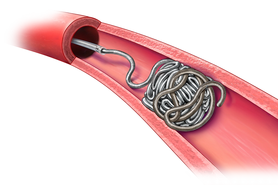 Illustration of POD embolization system packed and placed in a vessel within the body