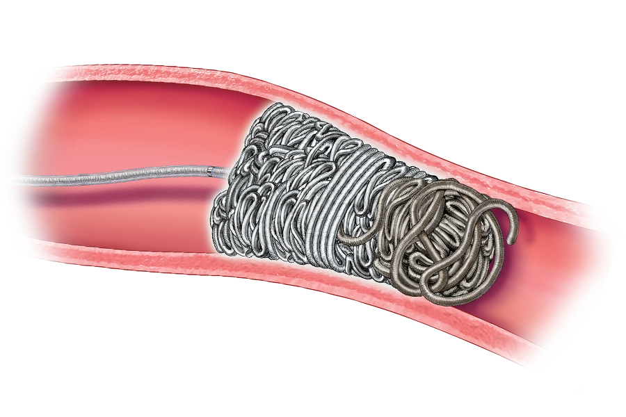 illustration of packing coil placed in a vessel in the body