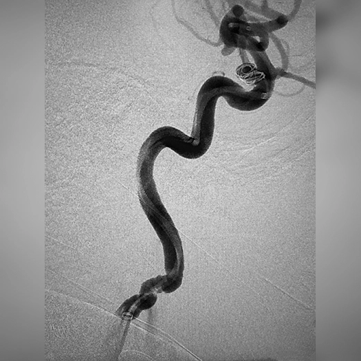 angiogram of catheter access tracking and embolization coil deployment in blood vessel