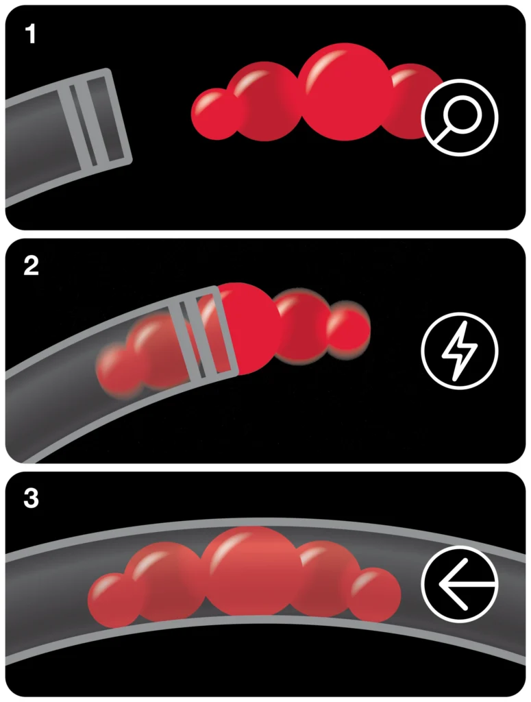 3Three-step illustration showing a catheter approaching a cluster of red particles in a vessel (step…