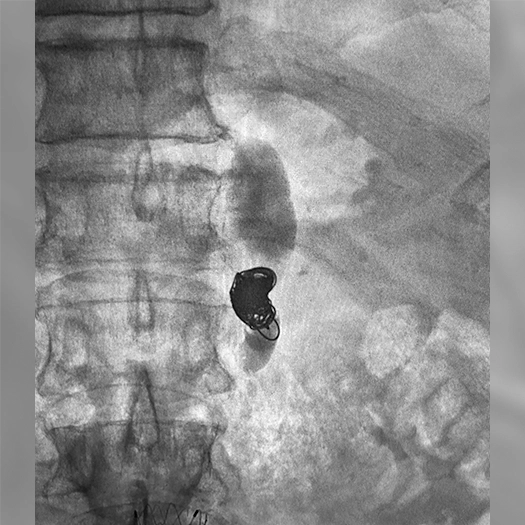 ANGIOGRAM OF EMBOLIZATION COIL DEPLOYED IN THE BODY