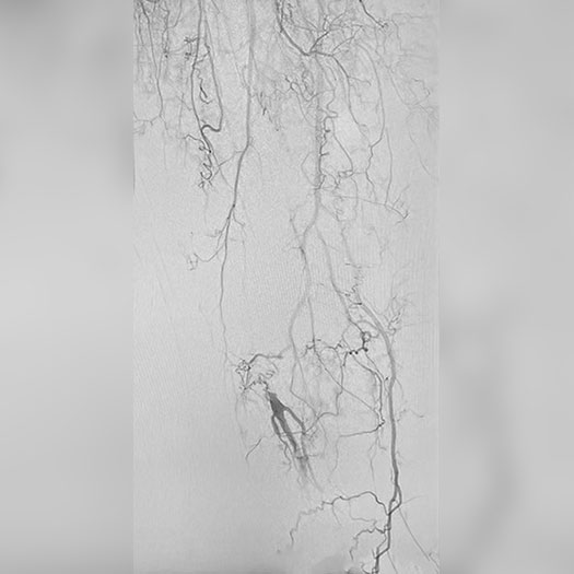 angiogram of occluded blood vessel