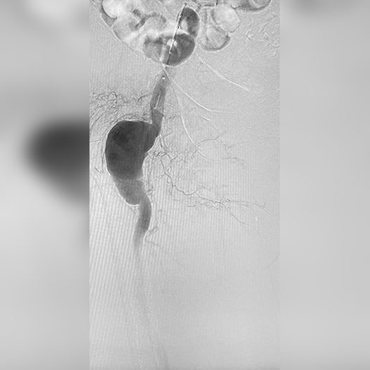 angiogram of occluded blood vessel