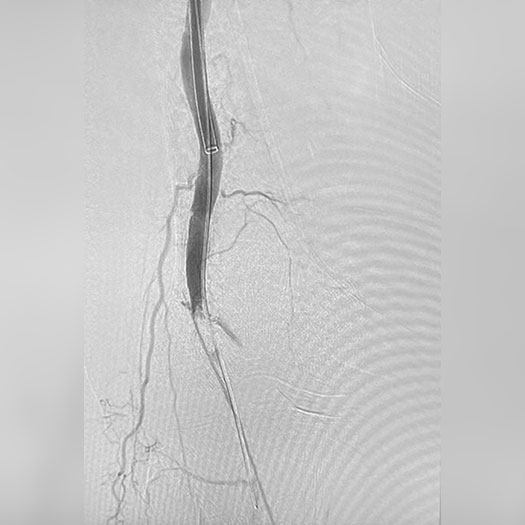 angiogram of occluded blood vessel