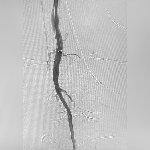 Angiogram of cleared blood vessel