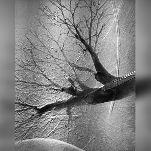 angiogram of cleared blood vessel in the lung