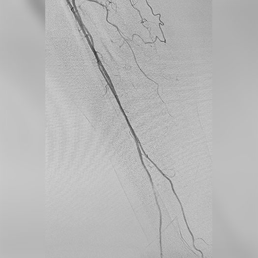 Angiogram of cleared blood vessel