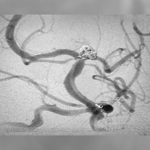 Angiogram of Basilar Tip Aneurysm post coiling