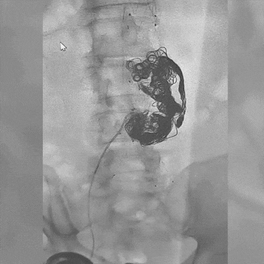 Angiogram of coils deployed in an aneurysm the body
