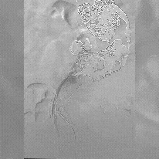 Angiogram of coils deployed in an aneurysm the body
