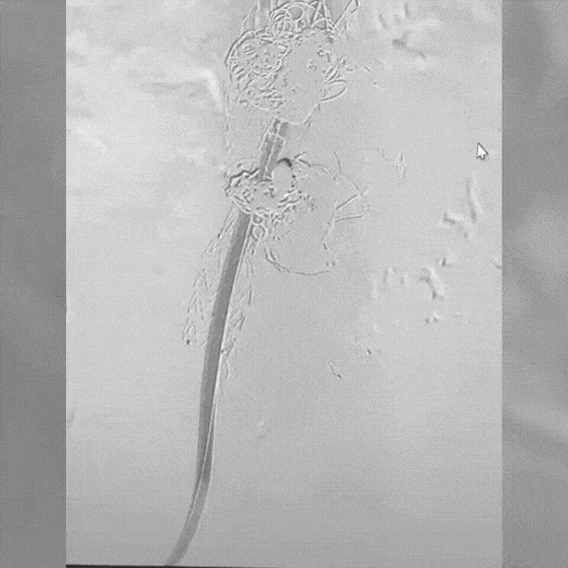 Angiogram of coils deployed in an aneurysm the body