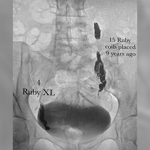 Angiogram of coils deployed in an aneurysm the body