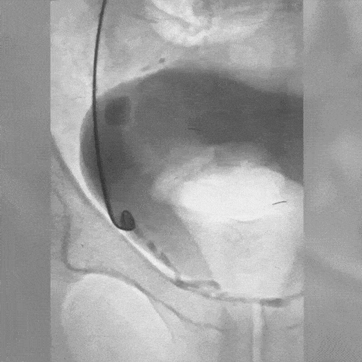 Angiogram of coils deployed in an aneurysm the body