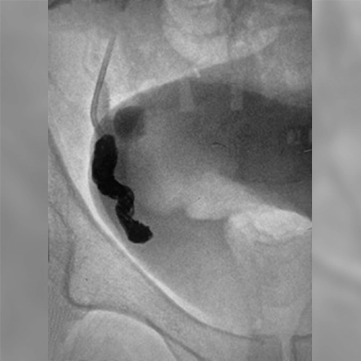 Angiogram of coils deployed in an aneurysm the body