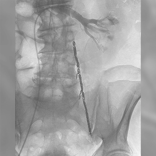 Angiogram of coils deployed in an aneurysm the body