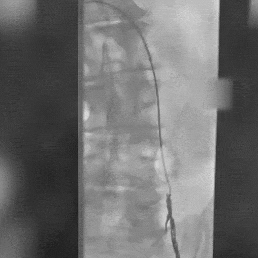 Angiogram of coils deployed in an aneurysm the body