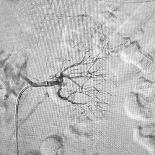 Angiogram of coils deployed in an aneurysm the body
