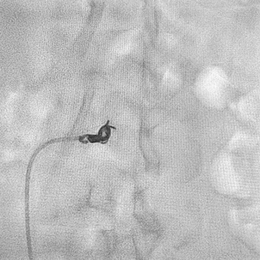 Angiogram of coils deployed in an aneurysm the body