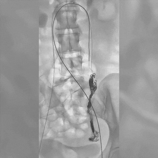 Angiogram of coils deployed in an aneurysm the body