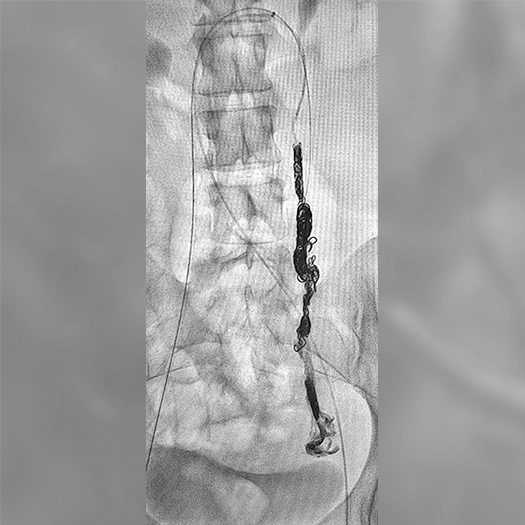 Angiogram of coils deployed in an aneurysm the body