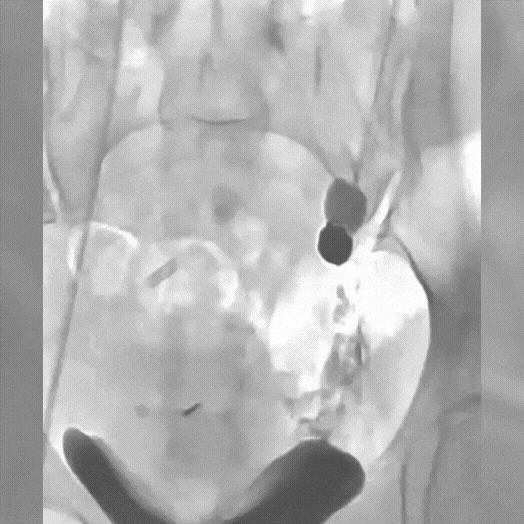 Angiogram of coils deployed in an aneurysm the body