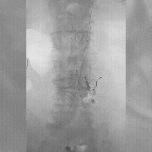 Angiogram of coils deployed in an aneurysm the body
