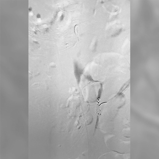 Angiogram of coils deployed in an aneurysm the body