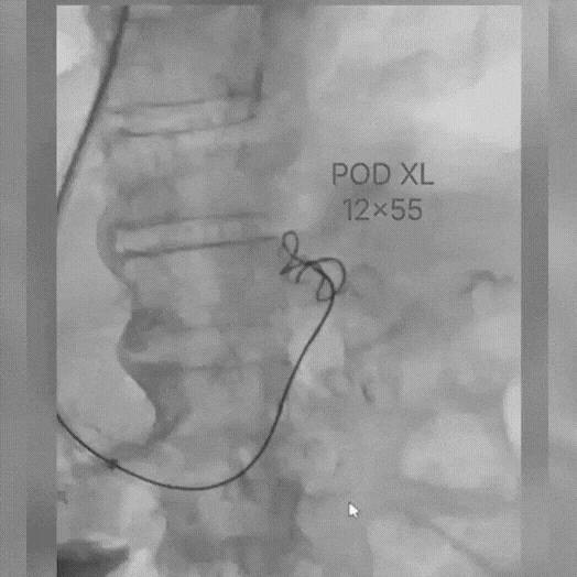 Angiogram of coils deployed in an aneurysm the body