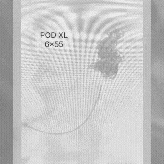 Angiogram of coils deployed in an aneurysm the body