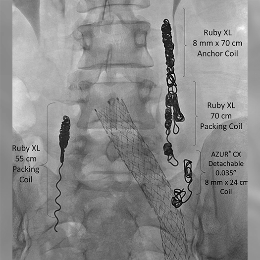 Angiogram of coils deployed in an aneurysm the body