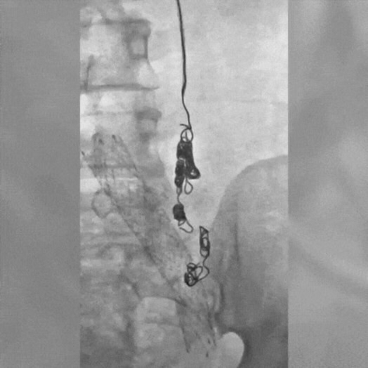 Angiogram of coils deployed in an aneurysm the body