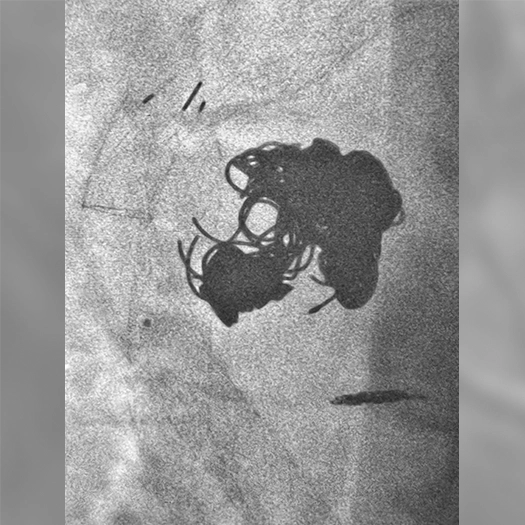 Angiogram of coils deployed in an aneurysm the body