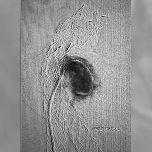 Angiogram of coils deployed in an aneurysm the body