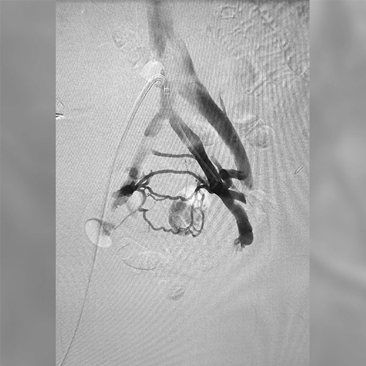 Angiogram of coils deployed in an aneurysm the body