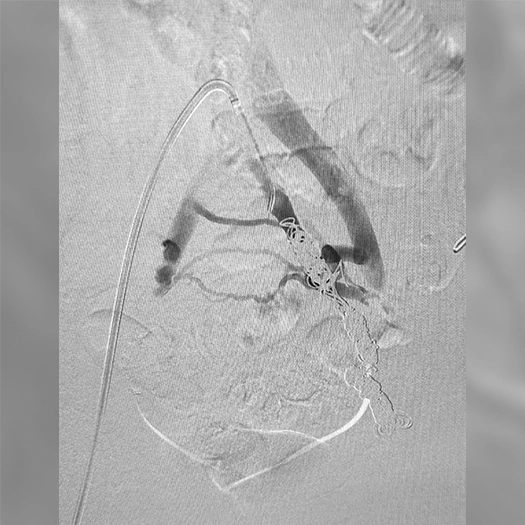 Angiogram of coils deployed in an aneurysm the body